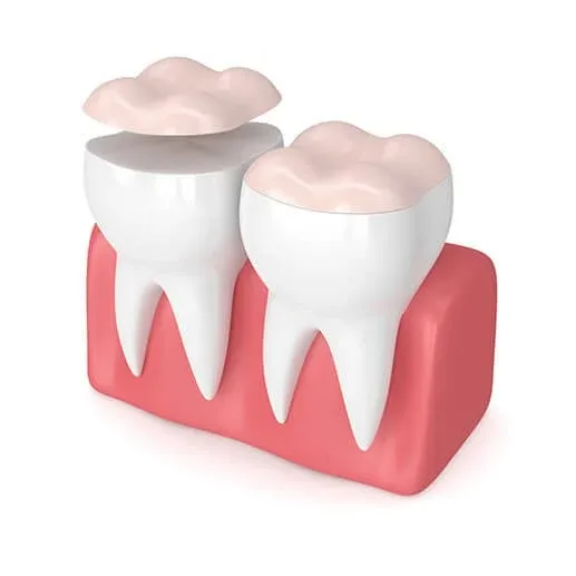 Three-dimensional render of a ceramic dental onlay lifted above a prepared molar
